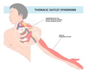 thorasic outlet syndrome diagram